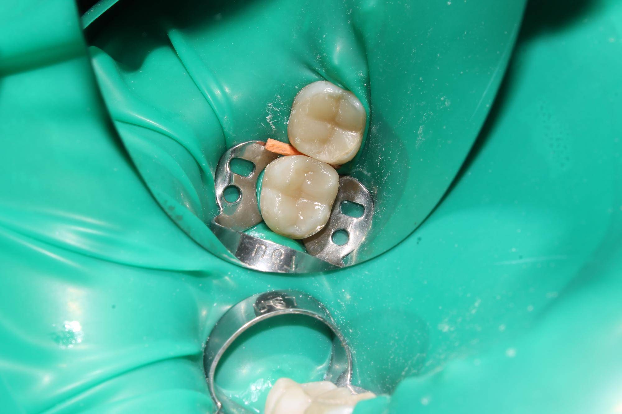 Jak stosować Ketac Fil Plus płyn 83ml 10g w codziennej stomatologii
